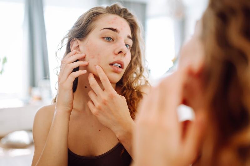 The Complete Guide to Safe Acne Treatment and Healthy Skin